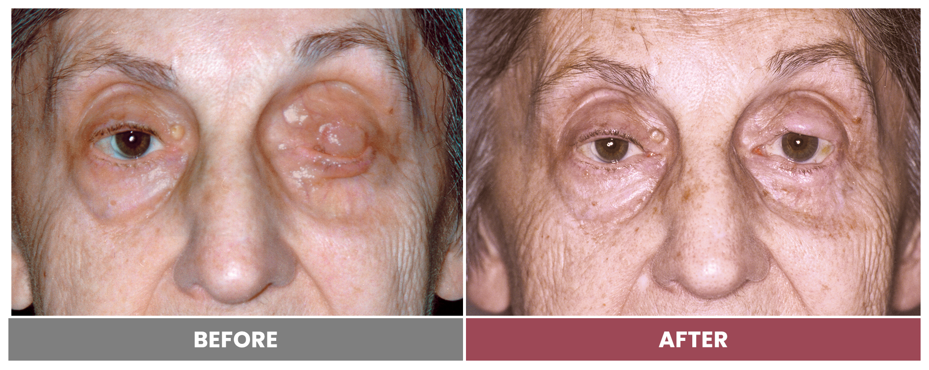 TUMOR REMOVAL AND RECONSTRUCTION - Case 1